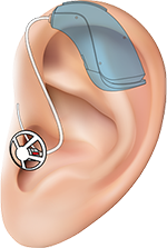 Заушные слуховые аппараты